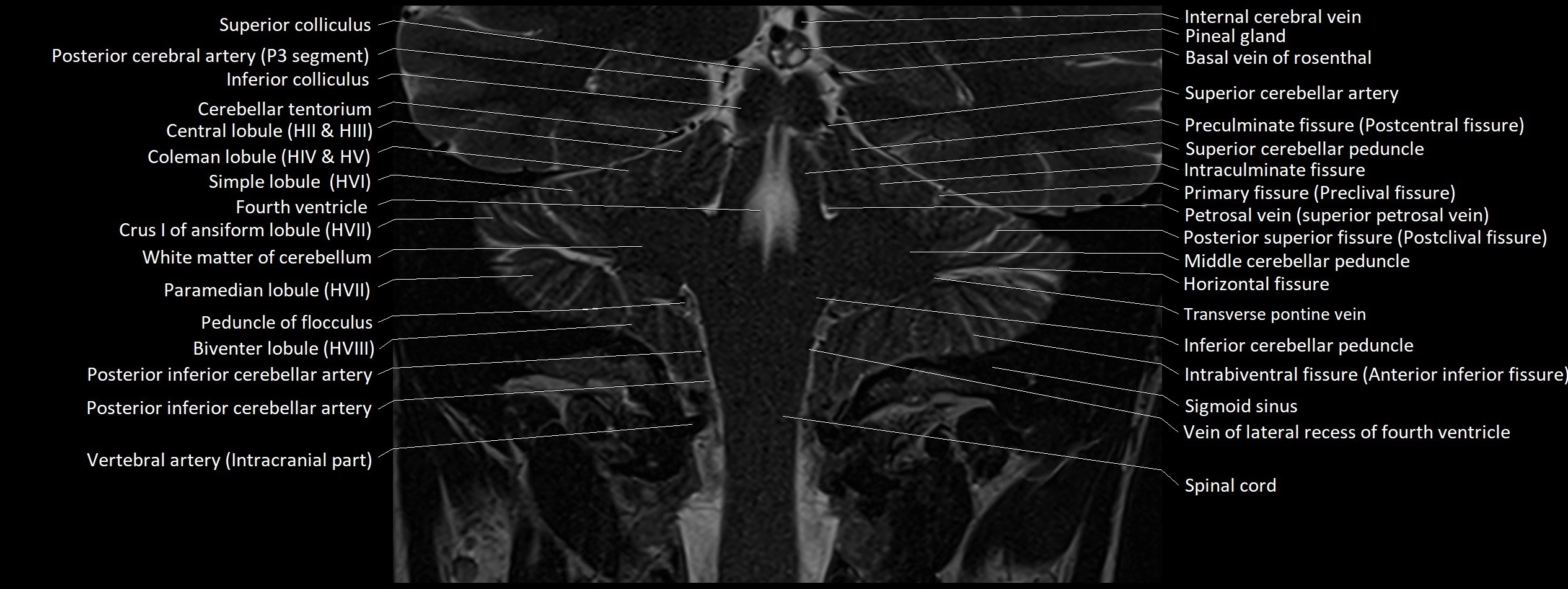 Anatomy of cerebellum coronal cross sectional 3T image 7.webp